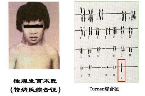 轉角病|特纳综合征